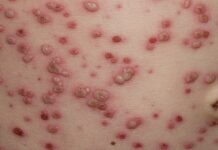 5 focare de varicelă în Olt