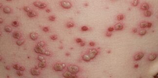 7 focare de varicelă în județul Olt de la începutul anului