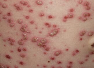 7 focare de varicelă în județul Olt de la începutul anului