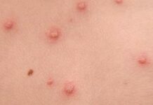 Ministerul Sănătății, precizări despre variola maimuței