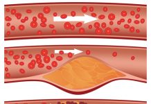 Care sunt valorile normale ale colesterolului și ce simptome apar când e prea mare