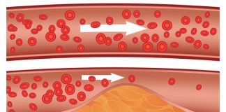Care sunt valorile normale ale colesterolului și ce simptome apar când e prea mare