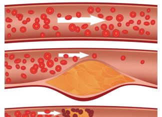 Care sunt valorile normale ale colesterolului și ce simptome apar când e prea mare