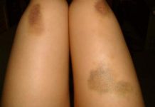 Îți apar vânătăi din senin? Iată care ar putea fi motivele