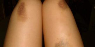 Îți apar vânătăi din senin? Iată care ar putea fi motivele