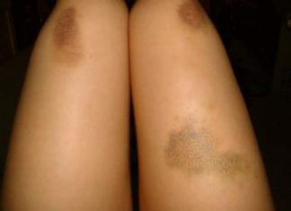 Îți apar vânătăi din senin? Iată care ar putea fi motivele