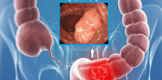 Semne de avertizare că aveți colonul plin de toxine. Cum îl curățați că să evitați 90% din BOLI