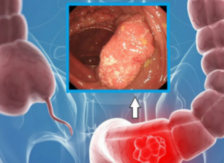 Semne de avertizare că aveți colonul plin de toxine. Cum îl curățați că să evitați 90% din BOLI
