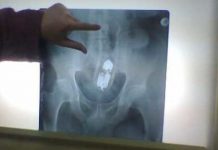 Tânărul din Brâncoveni cu tubul de deodorant în anus a fost operat