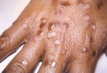 Un nou caz de variola maimuței în România