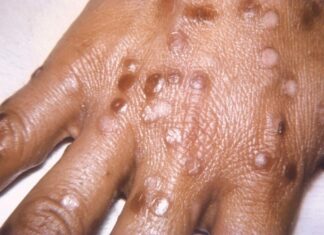 Un nou caz de variola maimuței în România