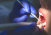 5 probleme dentare care pot fi descoperite la un control de rutină
